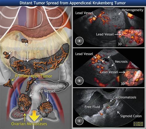Ovarian Tumors Clinical Setting And Us Radiology Key