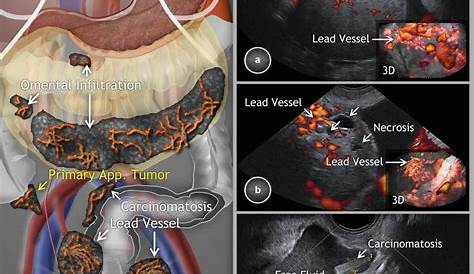 Ovarian Tumors (Clinical Setting and US) | Radiology Key