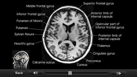 Ct Scan Brain Anatomy Ct Scan Anatomy Of Brain Anatomy Drawing