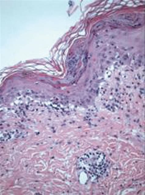 Approach To Perivascular Lymphocyctic Inflammation Nummular