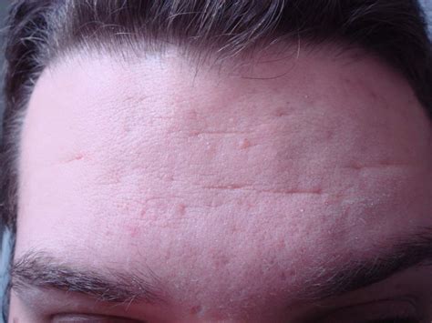 Scar Logs Pre Fraxel Treatment Forehead Ice Pick Scarring And Well