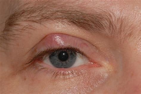 White Bump On Eyelid Eyelid Bumps 101 How To Identify Styes Milia