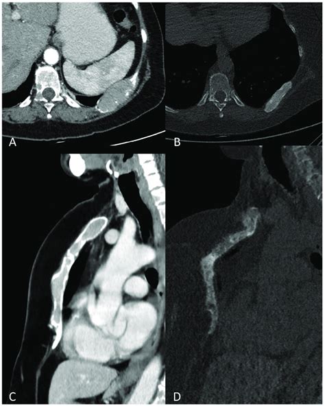 Multiplanar Ct Images Showing A An Osteolytic Lesion Of A Rib With