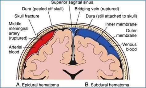 Symptoms of large and acute subdural hematoma. Differences between subdural and epidural hematoma ...
