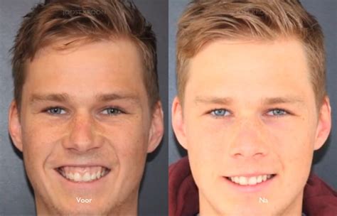 A nationally renowned gum reduction surgeon tells all. Gummy Smile / Tandvleeslach - Joost Kroon