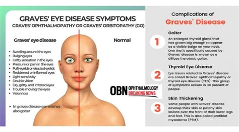 What Is Graves Eye Disease Obn