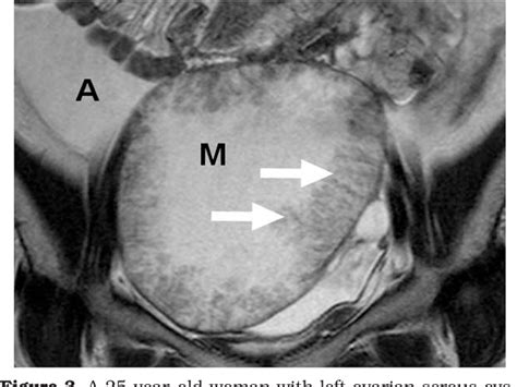 Cystic ovaries significantly decrease reproductive efficiency of affected animals, causing losses in milk production and, overall, monetary losses to the dairy. Figure 3 from MRI features of ovarian cystic lesions ...
