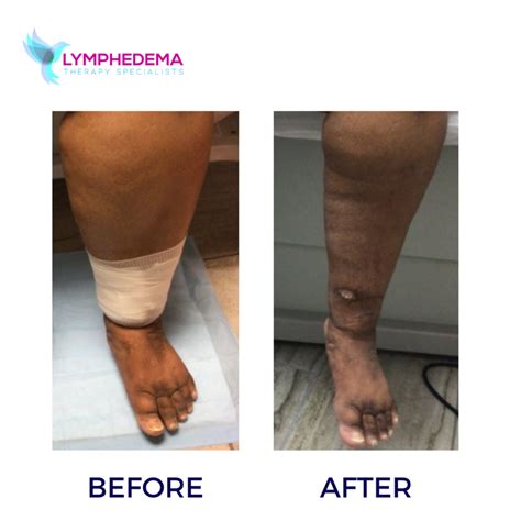 Wound Care Lymphedema Therapy Specialists