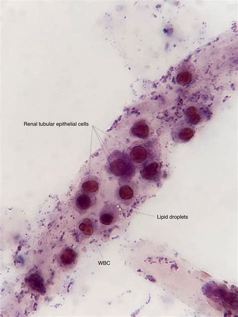 Urine Sediment Of The Month Renal Tubular Epithelial Cells Renal