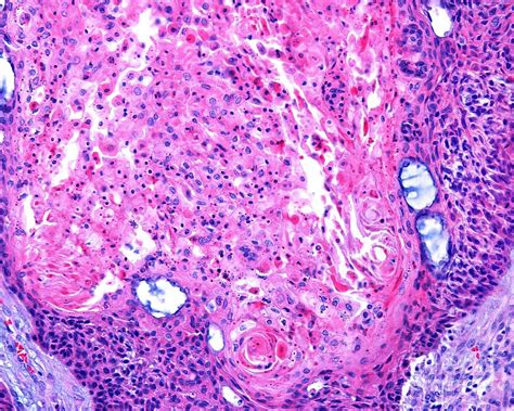 Squamous Cell Carcinoma Of The Larynx 2 Photograph By Jose Calvo
