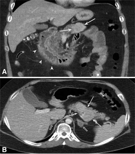 A Coronal Contrast Enhanced Computed Tomography Ct Of The Abdomen