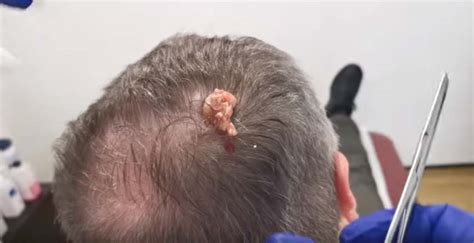 Massive Pilar Cyst Removed From The Scalp New Pimple