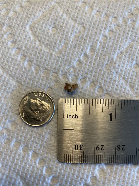 1 Year Later And Its Finally Out 7mm Stone Rkidneystones