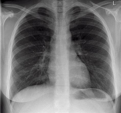 Reading The Chest X Ray Chest Radiography Identifying A Normal Chest X Ray Hubpages
