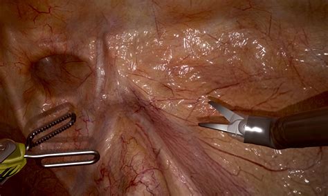 RobotiX- ADVANCED SURGERY – ROBOTIC INGUINAL HERNIA MODULE | Simbionix
