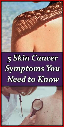 5 Skin Cancer Symptoms You Need To Know This Summer Healhty And Tips
