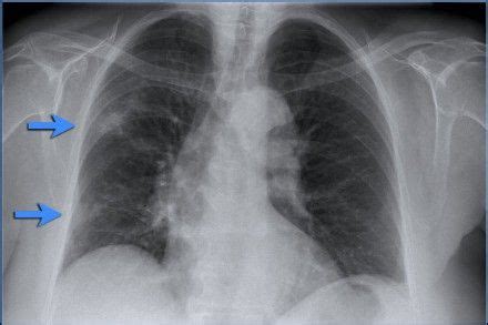 The Radiology Assistant Chest X Ray Lung Disease Lung Disease X Ray Disease