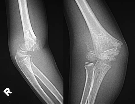 T Condylar Fractures Of The Distal Humerus In Children Report On Three