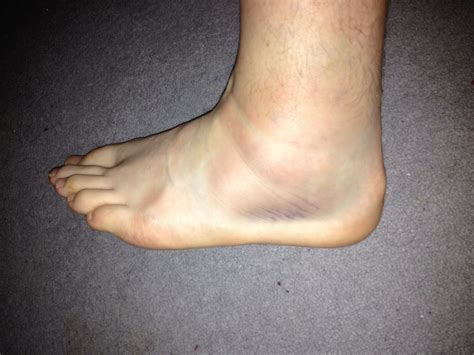 Simply Seanie Twisted Ankle And Ultra Marathon Hopes