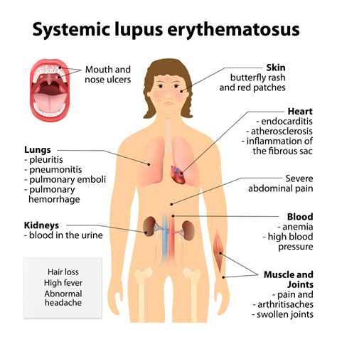 Systemic Lupus Erythematosus Houston Tx Rheumatology Infectious Diseases