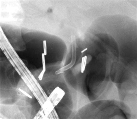 Percutaneous Balloon Dilation And Placement Of Endoscopic Biliary Stent