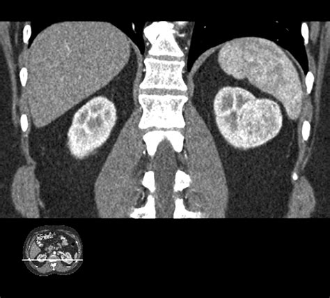 Metastatic Renal Cell Carcinoma Radiographics