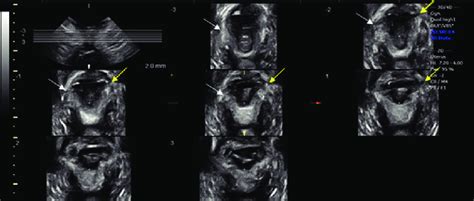 Transperineal Three Dimensional Ultrasound Using Tomographic Ultrasound Download Scientific