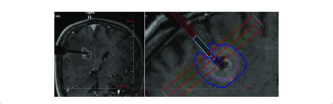 Intraoperative Mri Monitoring Of Litt After Stereotactic Placement Of