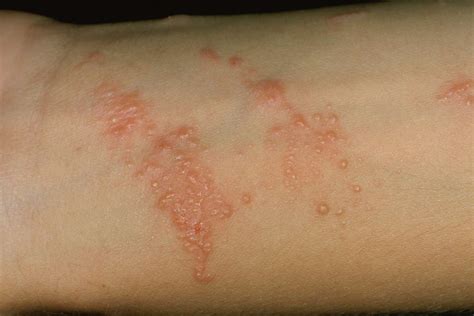 What Does Poison Ivy Rash Look Like Austra Health