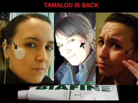 Passer de la glace sur la brulure si c'est à la main, tu frottes l'endroit par exemple contre les parois du congélateur, pui application de biafine. Biafine topical emulsion - Биафине топицал емулсион