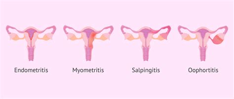 Types Of Pelvic Inflammatory Diseases Pid