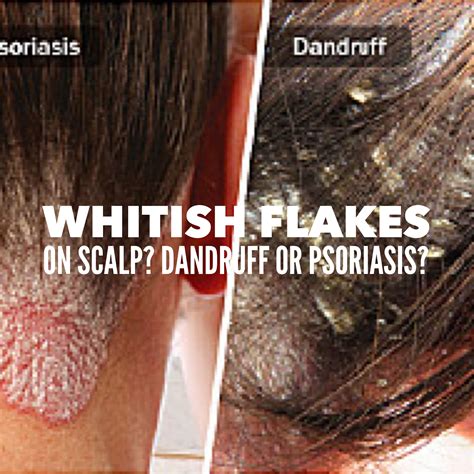Scalp Psoriasis Vs Dandruff Scratching Scalp Psoriasis Dandruff Picking And Causes