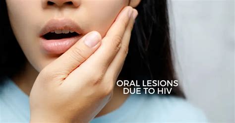 Oral Lesions Due To HIV