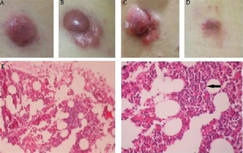 Cutaneous Anaplastic Large Cell Lymphoma In A Multiple Sclerosis