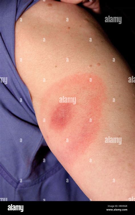 Lyme Disease Bullseye Stock Photo Alamy