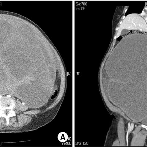 Contrast Enhanced Ct Scans Show A 439×283×347 Cm Cystic Mass With