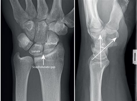 Scapholunate Ligament Injuries Fife Virtual Hand Clinic