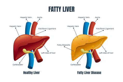 Fatty Liver Disease Liver Transplant Hospitals Chennai Liver Foundation