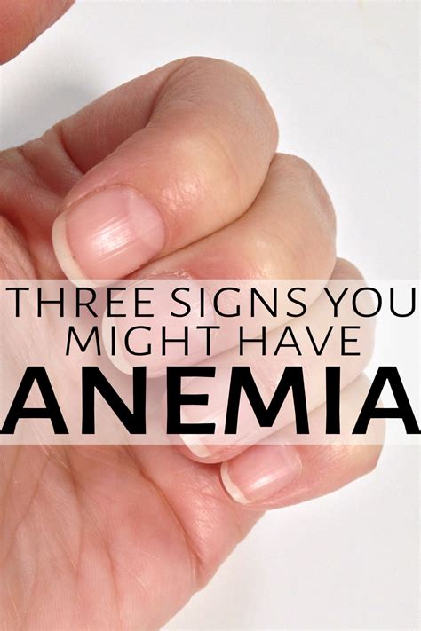 3 Signs Of Anemia For Self Checks Snappy Living