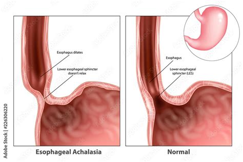Esophageal Achalasia Treatment Hot Sex Picture