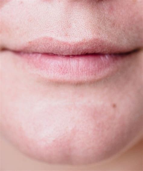 White Bumps On Lips Causes Symptoms And Effective Remedies