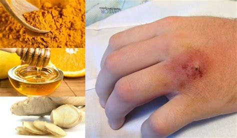 22 Amazing Home Remedies For Staph Infection