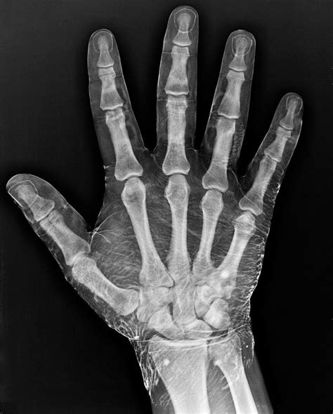 Radiograph Of A Hand Dipped In Iodine Anatomy For Artists X Ray