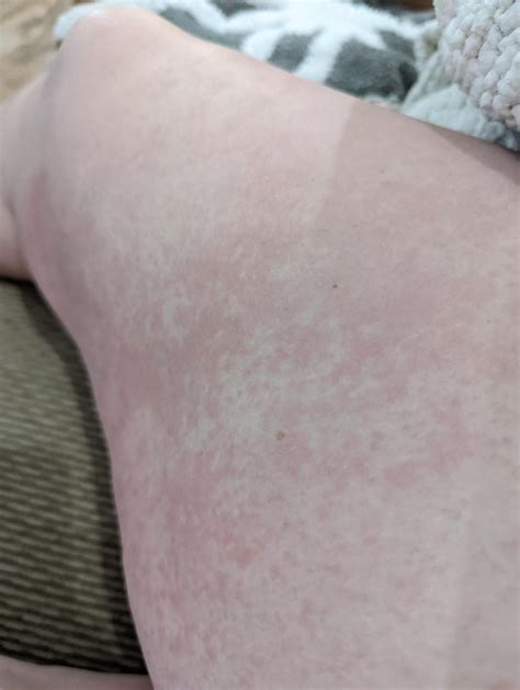 Rash On Inner Thighs F 31 Not Itchy Or Raised What Do You Think It