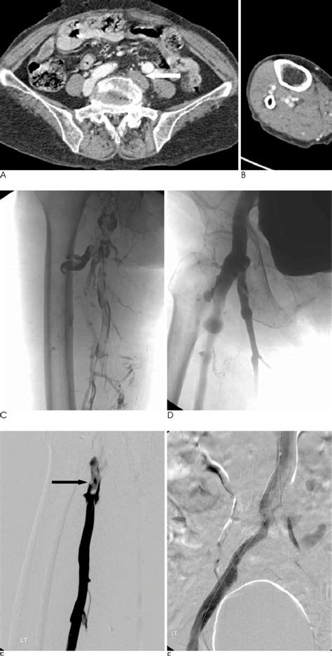 Images From An 82 Year Old Woman With Acute Left Leg Swelling A B A