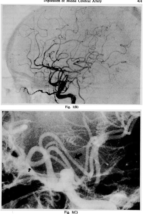 Figure 1 From Triplication Of The Middle Cerebral Artery Associated