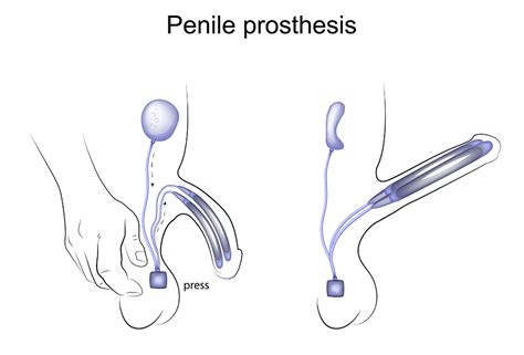 Penile Implants Hossein Sadeghi Nejad M D F A C S