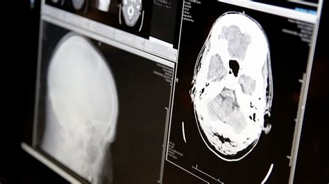 Two New Treatments For Glioblastoma The Check Up Youtube