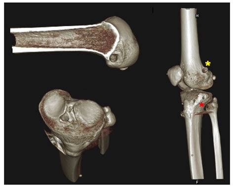 Medicina Free Full Text Outcomes Of Combined Anterior Cruciate