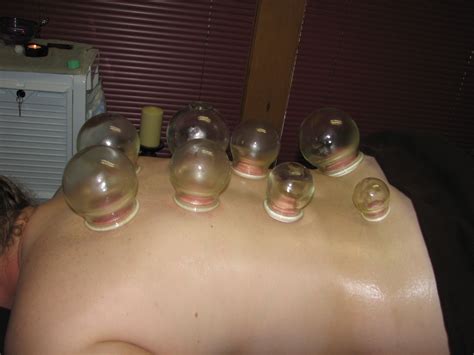 Cupping Therapy